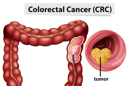 Le cancer colorectal augmente chez les jeunes, et une toxine bactérienne en serait responsable