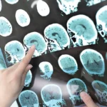 Un nouveau traitement ralentit les symptômes de la maladie d'Alzheimer