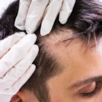 La chute des cheveux pourrait bien trouver une solution avec un traitement à base de sucre