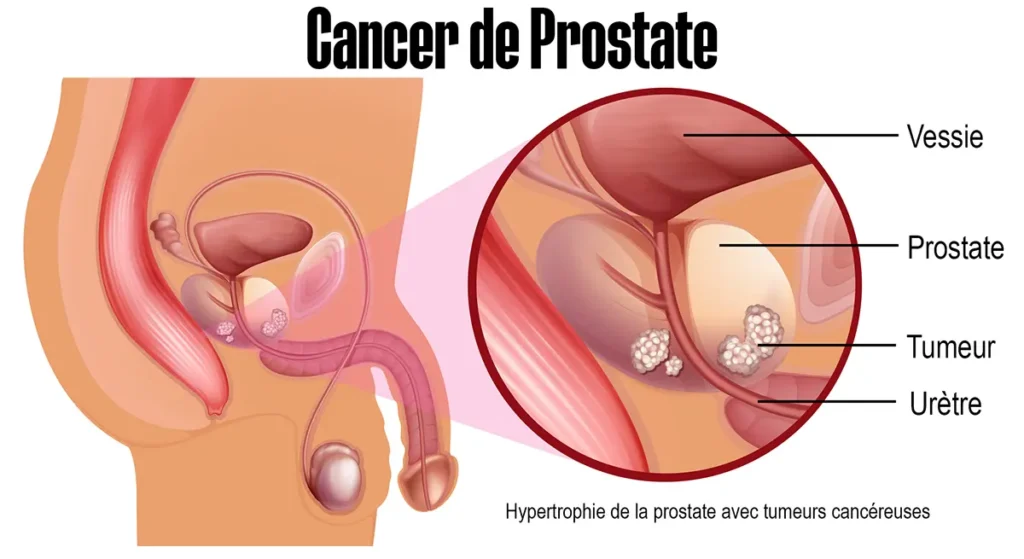 Selon une étude de l'université Harvard, éjaculer plus souvent réduirait les risques de cancer de la prostate