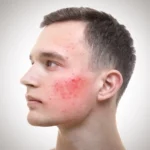 Dysbiose intestinale et acné, la cause invisible que la science confirme enfin