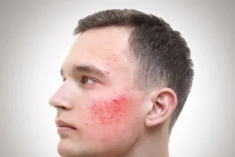 Dysbiose intestinale et acné, la cause invisible que la science confirme enfin