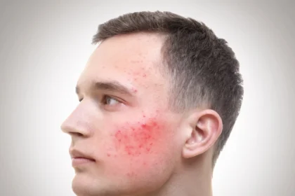 Dysbiose intestinale et acné, la cause invisible que la science confirme enfin